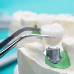 Cuáles son los factores de riesgo en los implantes dentales