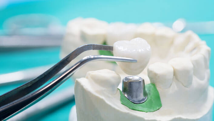 Cuáles son los factores de riesgo en los implantes dentales