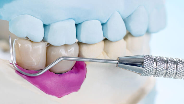 Los riesgos de escoger implantes dentales low cost