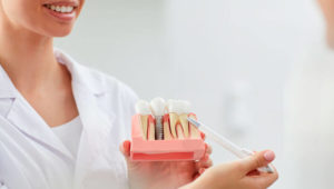 ¿Qué elementos integran un implante dental?