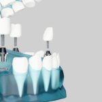 Descubre los beneficios de tener implantes dentales