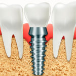 Comparamos implantes dentales con dentaduras postizas y puentes