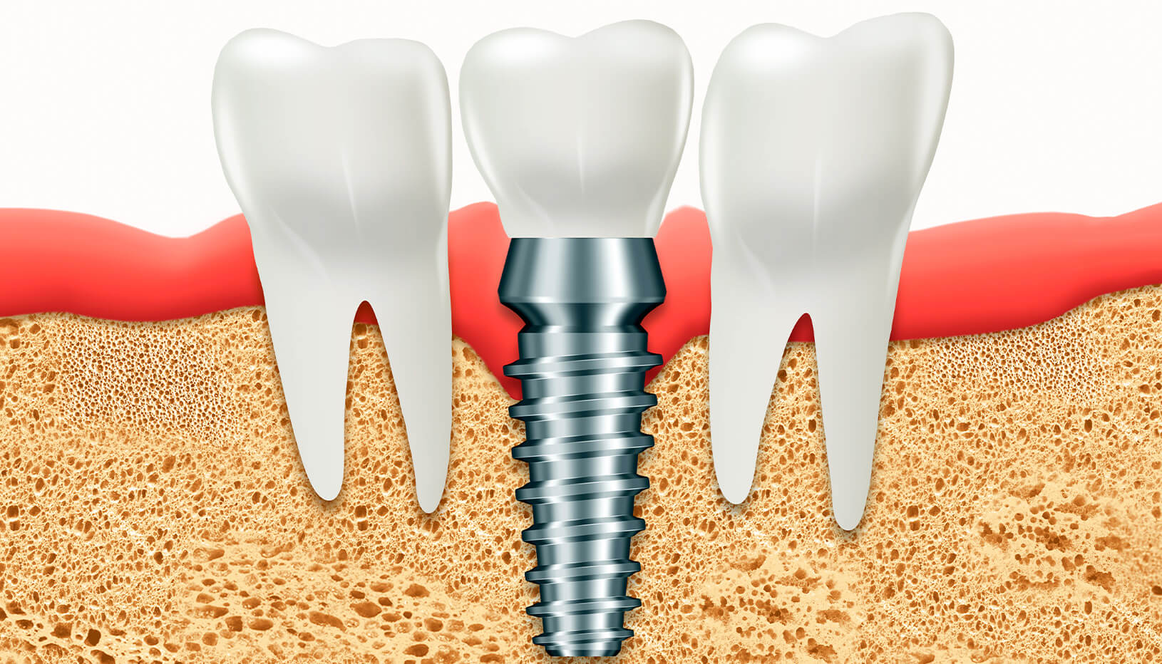 Comparamos implantes dentales con dentaduras postizas y puentes